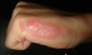 burns-treatment-tunisia