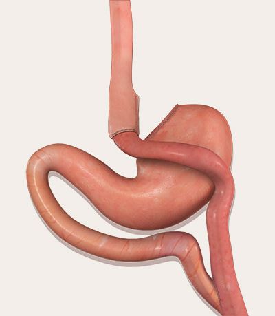 gastric-bypass-tunisia