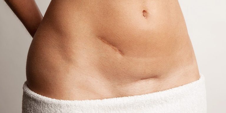 scars-treatment-tunisia