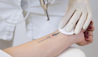 tattoo-removal-tunisia
